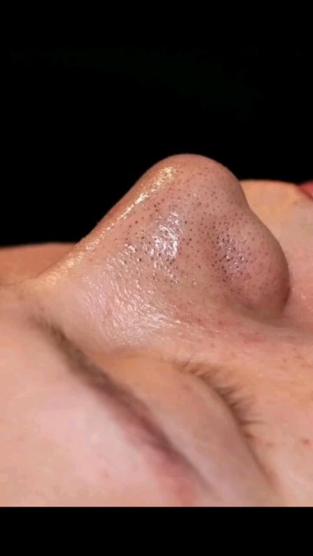 Blackhead and Whitehead Removal 🌟 #skincare #removal #masmurakayshoppe #pores #blackhead #whitehead